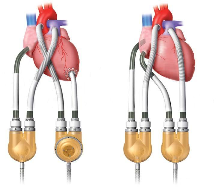 Сколько весит искусственный левый желудочек для сердца